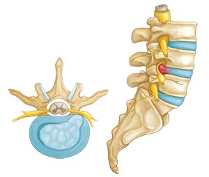 disc bulge causing sciatica